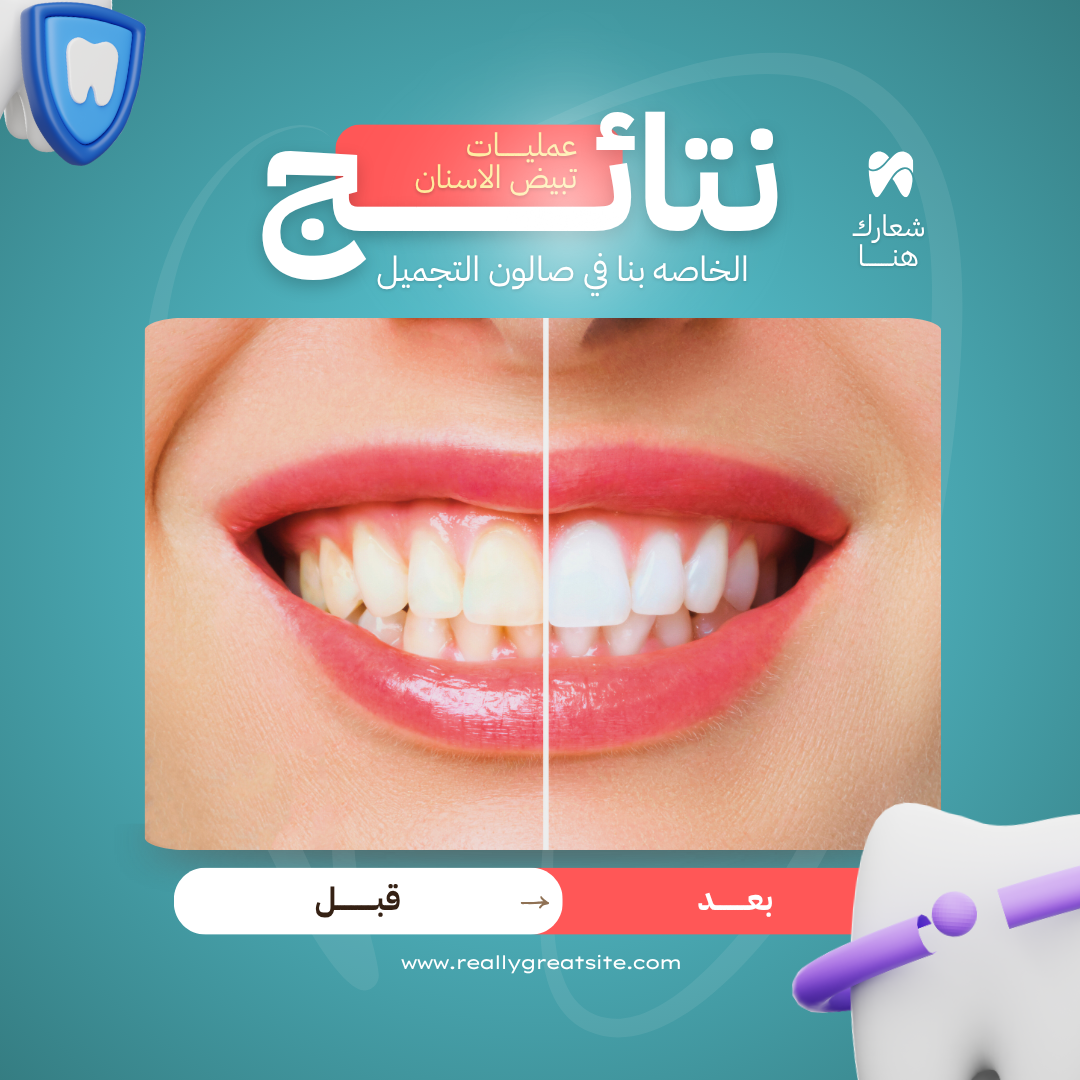 تبيض الأسنان قبل وبعد صالون تجميل
